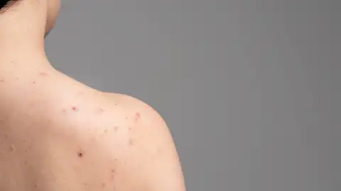 Granos en el cuerpo Granos en el cuerpo