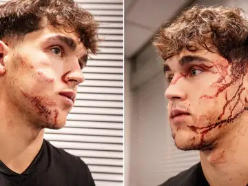 Las heridas de Pau Cubarsí Las heridas de Pau Cubarsí