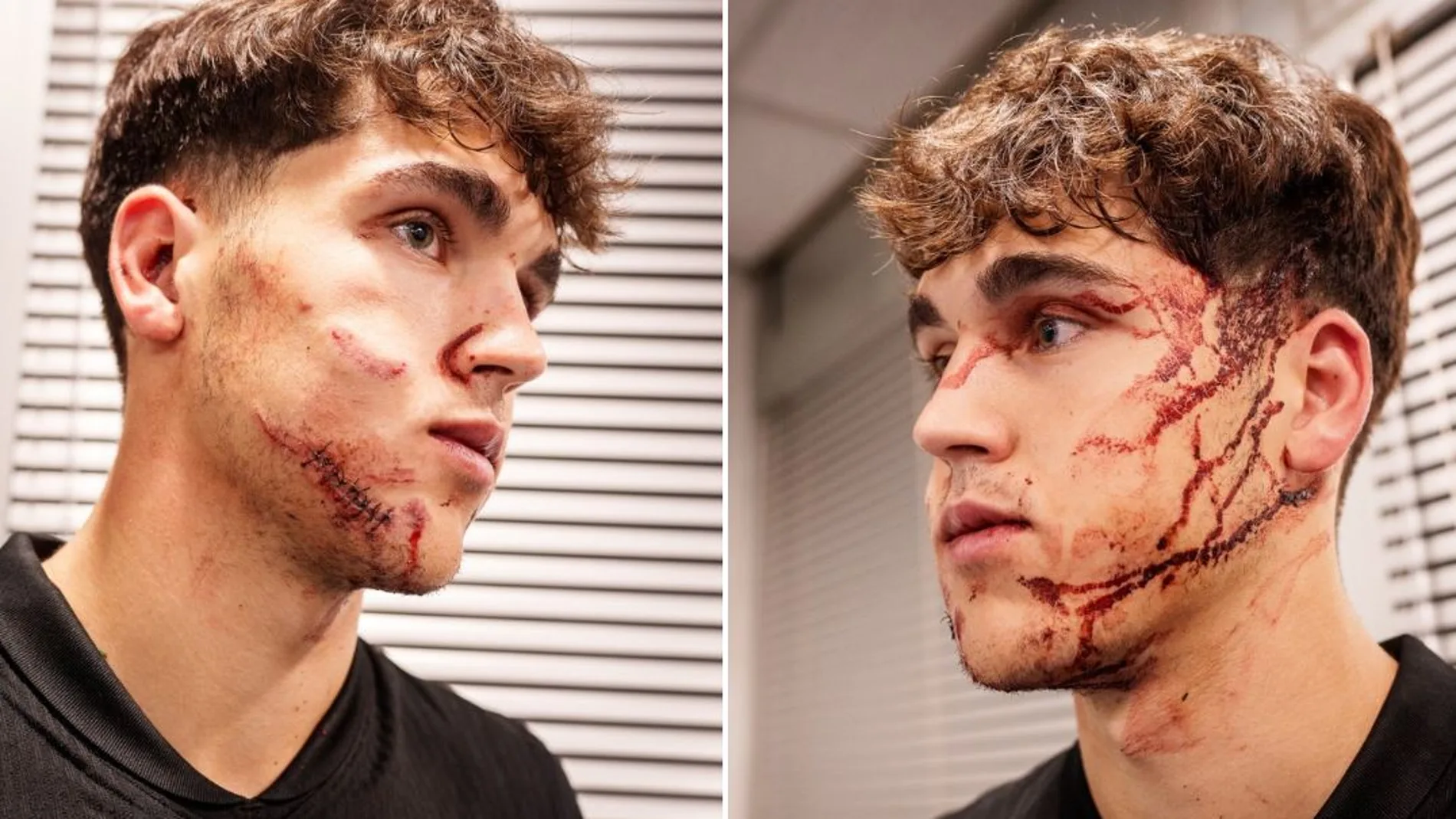 Las heridas de Pau Cubarsí Las heridas de Pau Cubarsí