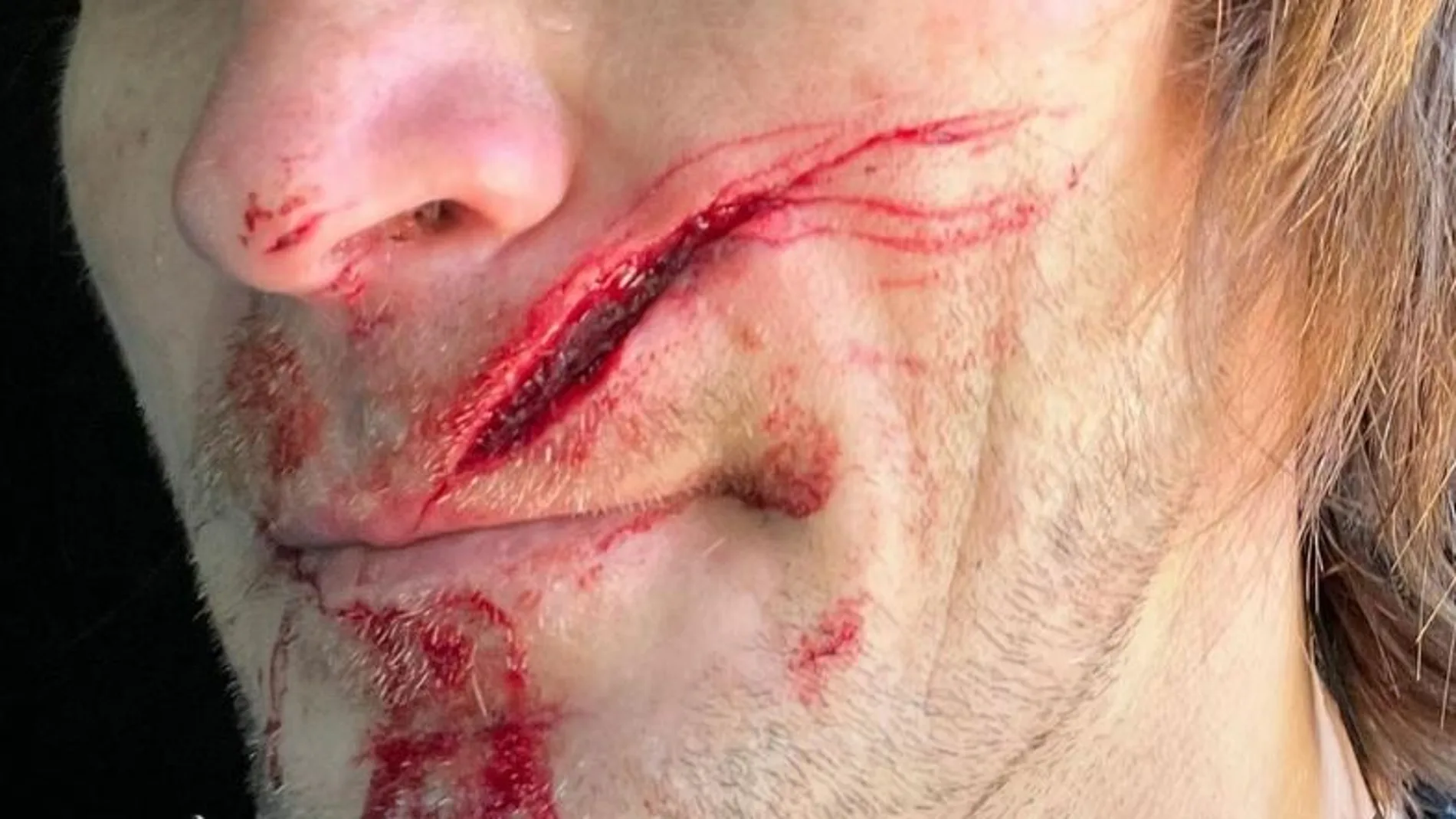 Taddy Blazusiak tras el grave accidente entrenando Taddy Blazusiak tras el grave accidente entrenando