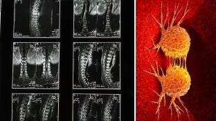Imagen de archivo de una columna vertebral y de c&eacute;lulas cancerosas.