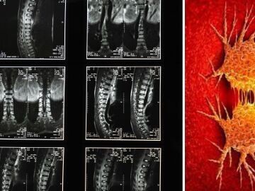 Imagen de archivo de una columna vertebral y de células cancerosas.