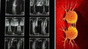 Imagen de archivo de una columna vertebral y de células cancerosas.