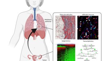 Estos son los síntomas que las mujeres no deben ignorar porque son señales de alerta del cáncer de cuello uterino