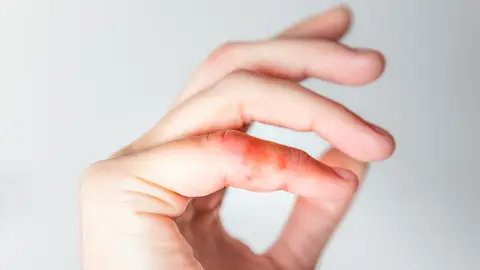 Sabañones Sabañones