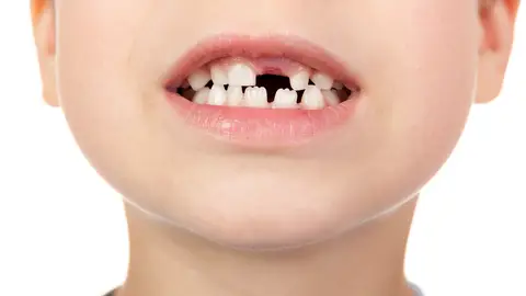 Niño sin un diente Niño sin un diente