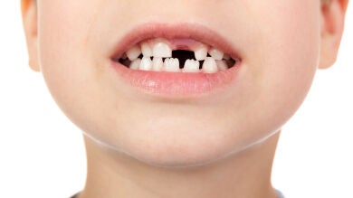 Una dentista explica qué debes hacer si tu hijo pierde un diente por un golpe