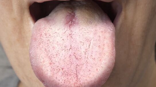 Si tu lengua tiene este color, tu cuerpo podr&iacute;a estar enviando una se&ntilde;al de alerta
