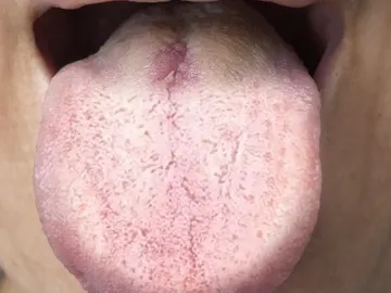 Si tu lengua tiene este color, tu cuerpo podría estar enviando una señal de alerta Si tu lengua tiene este color, tu cuerpo podría estar enviando una señal de alerta