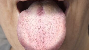 Si tu lengua tiene este color, tu cuerpo podría estar enviando una señal de alerta