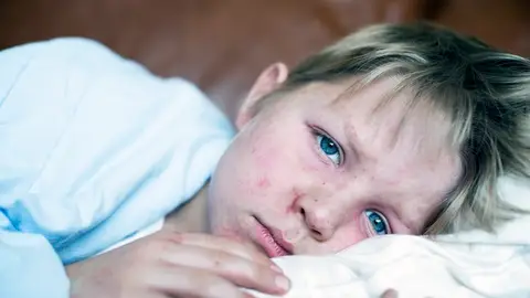 Niño con sarampión Niño con sarampión