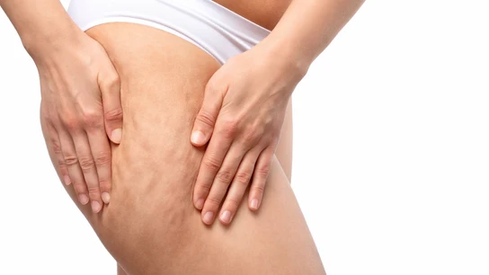 Celulitis Celulitis