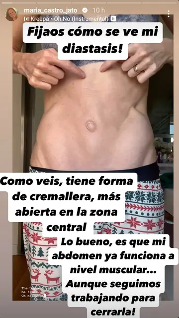 María Castro enseña la diástasis abdominal María Castro enseña la diástasis abdominal