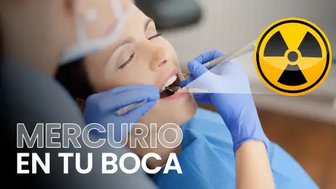 Infografía sobre los empastes de amalgama Infografía sobre los empastes de amalgama
