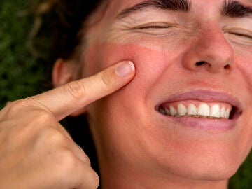 Mujer con la cara quemada