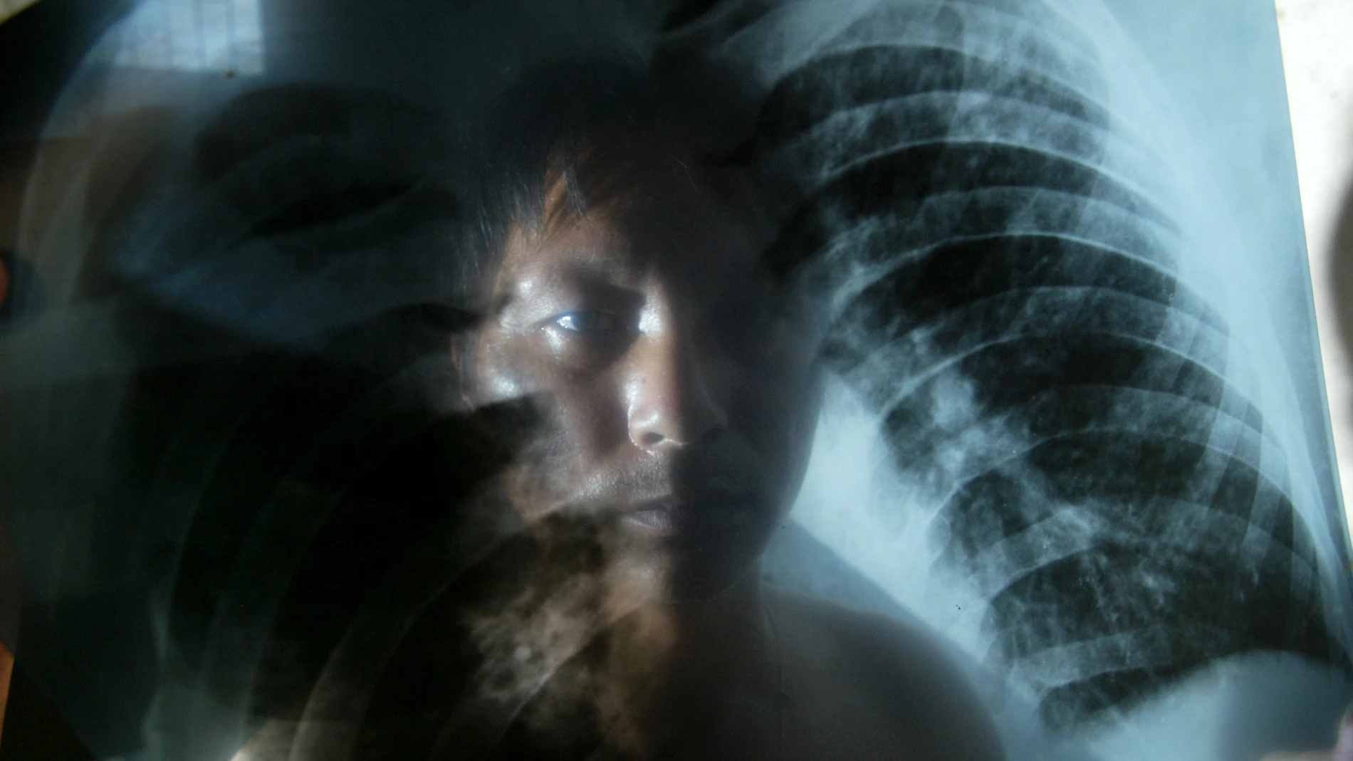 Imagen de uno de los ex trabajadores de la fábrica Lucky Gems and Jewellery que están demandando a la empresa por no compensarlos por contraer silicosis mientras trabajaban en Huizhou, Shenzhen. Imagen de uno de los ex trabajadores de la fábrica Lucky Gems and Jewellery que están demandando a la empresa por no compensarlos por contraer silicosis mientras trabajaban en Huizhou, Shenzhen.