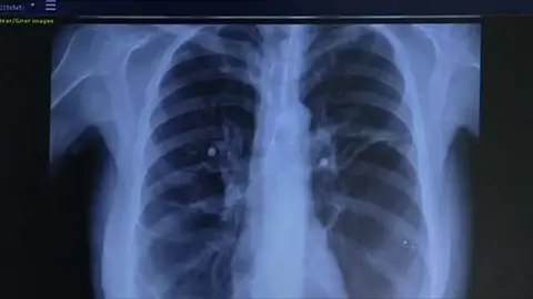 Administrar células madre en los pulmones de pacientes al borde de la muerte Administrar células madre en los pulmones de pacientes al borde de la muerte