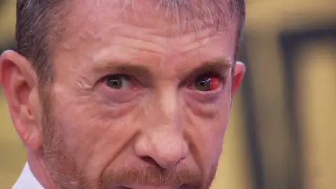 Pablo Motos confiesa el motivo del derrame en su ojo: "Ha sido en un entrenamiento de boxeo" Pablo Motos confiesa el motivo del derrame en su ojo: "Ha sido en un entrenamiento de boxeo"