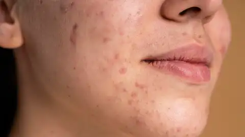 Chica con acné Chica con acné