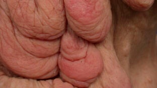 Imagen de un caso de neurofibromatosis.