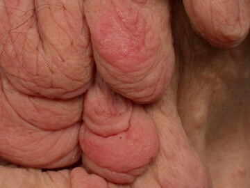 Imagen de un caso de neurofibromatosis.