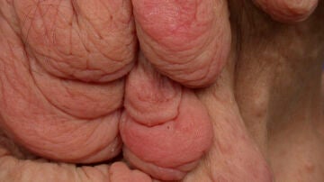 Imagen de un caso de neurofibromatosis.