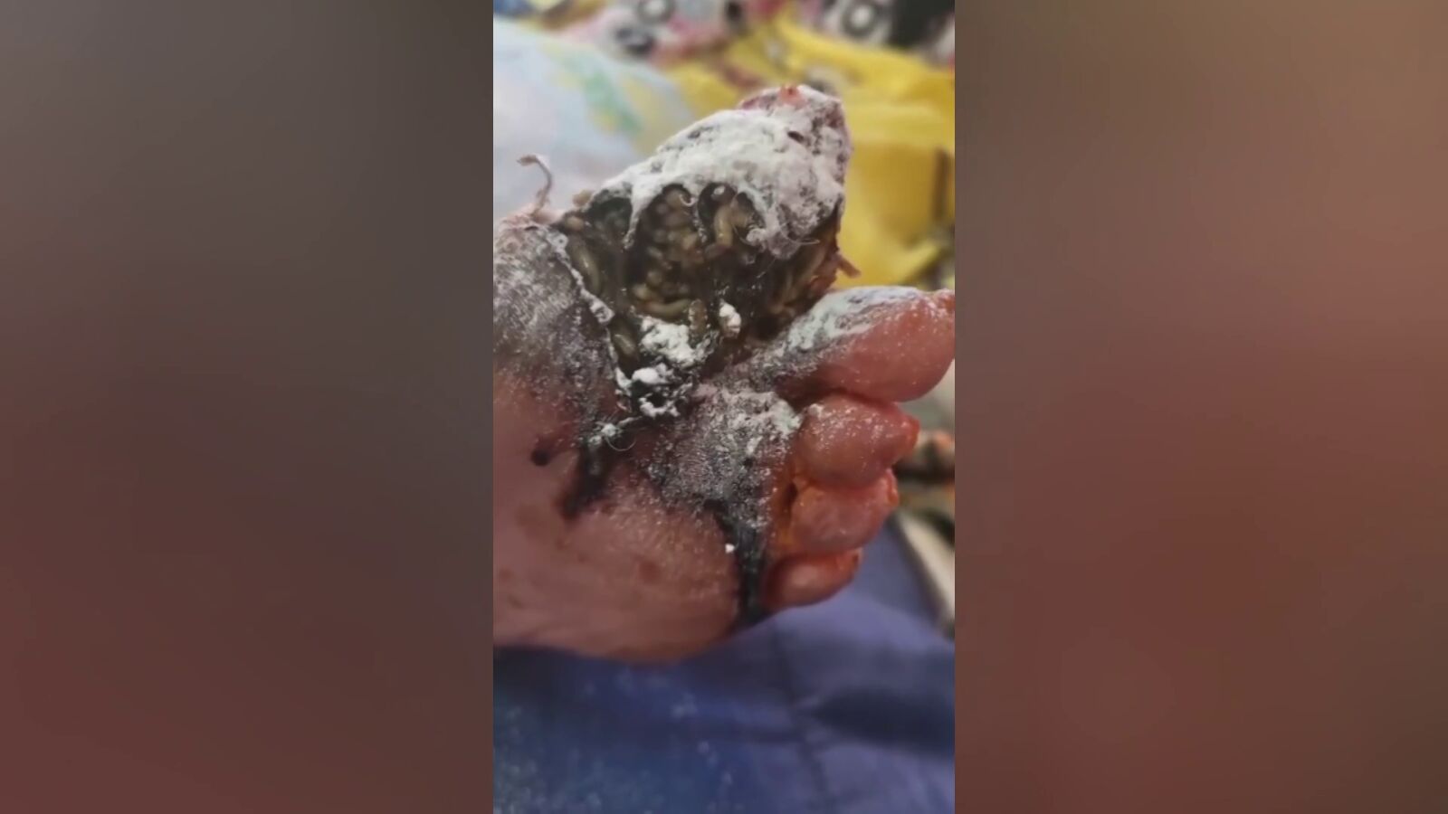Trasladan de urgencia al hospital de Algeciras a una anciana con gangrena y gusanos en los pies: 