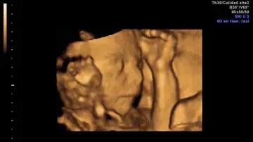 Técnica para tartar las cardiopatías en bebés Técnica para tartar las cardiopatías en bebés