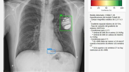 Radiograf&iacute;a de pulmones
