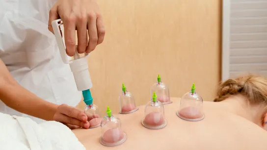 Terapia con ventosas Terapia con ventosas