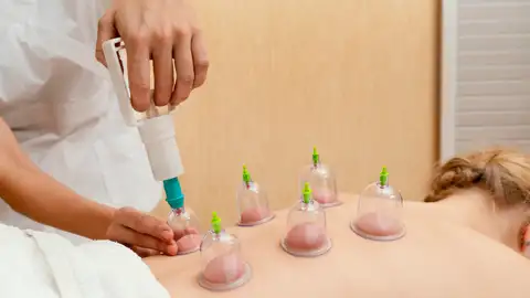 Terapia con ventosas Terapia con ventosas