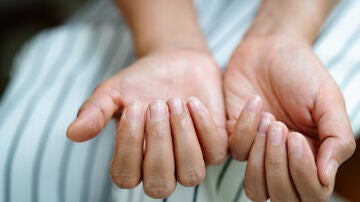 Uñas dañadas
