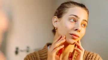 Chica con acné Chica con acné