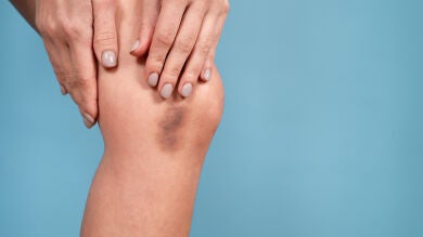 ¿Te ha salido alguna vez un moratón sin haberte dado ningún golpe? Estas son las causas que los provocan