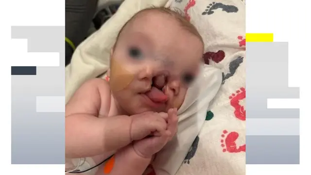 Un bebé con un raro defecto congénito será operado para reconstruir su cara partida en dos