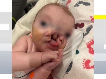 Un bebé con un raro defecto congénito será operado para reconstruir su cara partida en dos