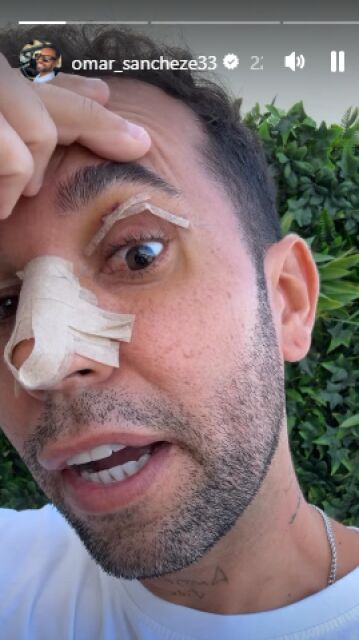 Omar Sánchez enseñando su cicatriz del párpado