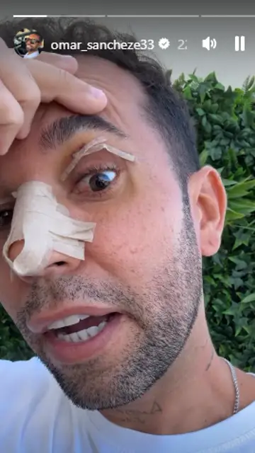Omar Sánchez enseñando su cicatriz del párpado Omar Sánchez enseñando su cicatriz del párpado