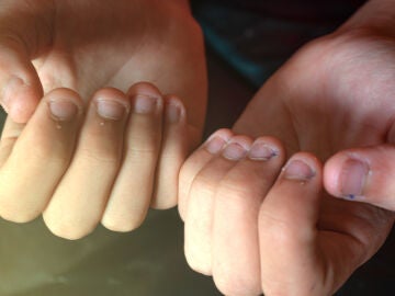 U&ntilde;as mordidas