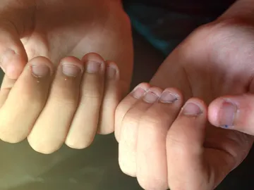 Uñas mordidas Uñas mordidas