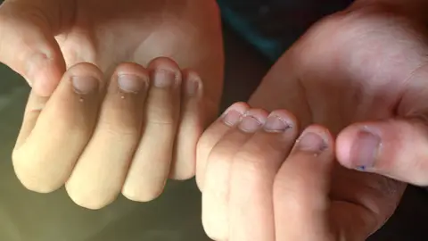 Uñas mordidas Uñas mordidas