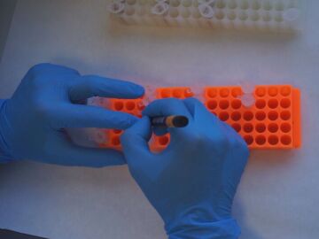 Un análisis de sangre que detecta el Alzheimer