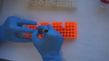 Un análisis de sangre que detecta el Alzheimer Un análisis de sangre que detecta el Alzheimer