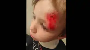 Un niño de 5 años, atropellado con un patinete por otro menor Un niño de 5 años, atropellado con un patinete por otro menor