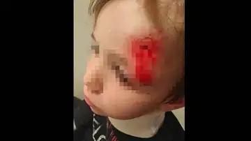 Un niño de 5 años, atropellado con un patinete por otro menor Un niño de 5 años, atropellado con un patinete por otro menor