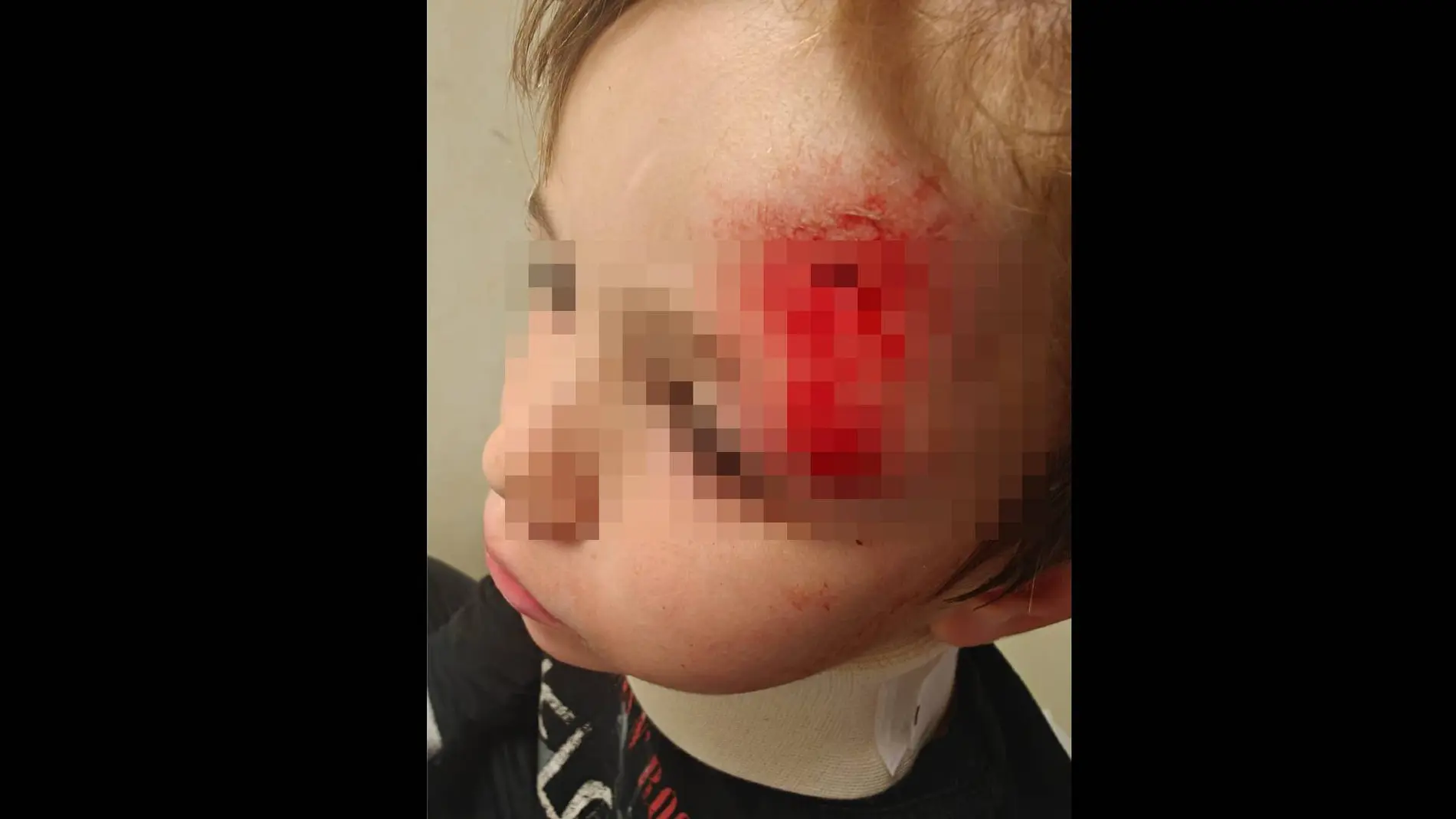 Un niño de 5 años, atropellado con un patinete por otro menor Un niño de 5 años, atropellado con un patinete por otro menor