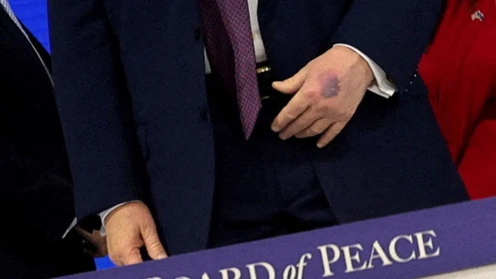 El moratón de Trump en la mano El moratón de Trump en la mano
