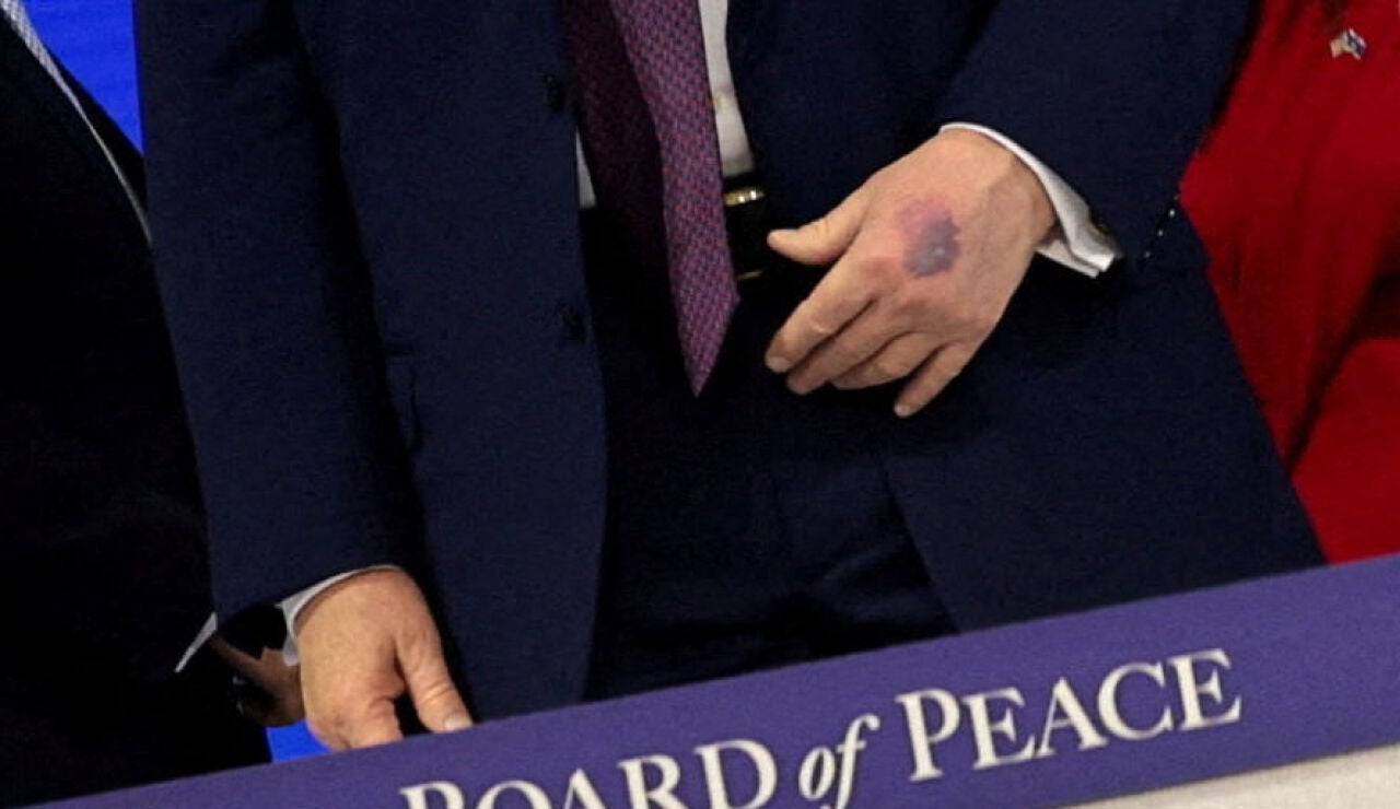 El morat&oacute;n de Trump en la mano