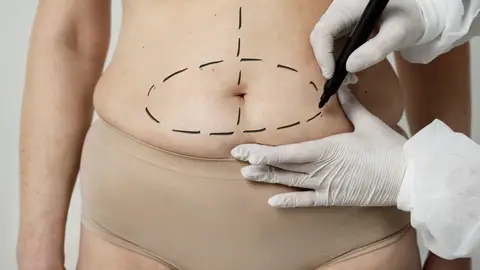 Retoque del abdomen Retoque del abdomen