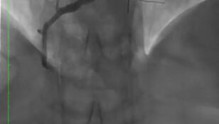 Resultado del f&aacute;rmaco liberado con el bal&oacute;n con la arteria abierta